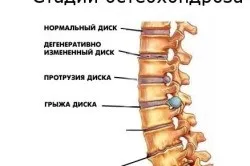 Види масажерів, корисних при остеохондрозі (остеохондрозі) Види масажерів, корисних при остеохондрозі