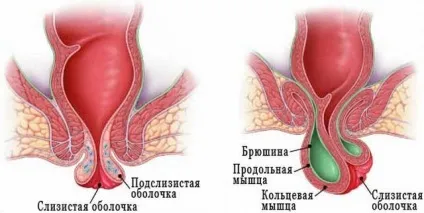 Випадання прямої кишки у дітей причини, симптоми і лікування ректального пролапсу (причини) Випадання прямої кишки у дітей причини, симптоми і лікування ректального пролапсу
