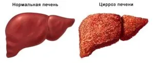 Висипання і плями на шкірі при захворюваннях печінки (фото) (шкірі) Висипання і плями на шкірі при захворюваннях печінки (фото)