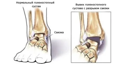 вивих стопи