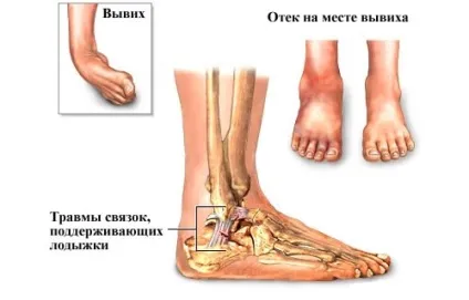 вивих стопи