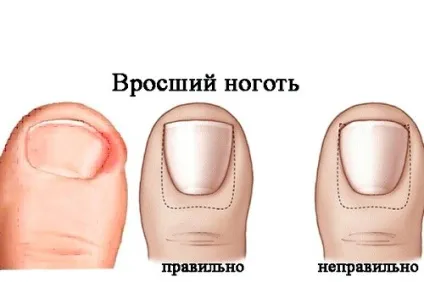 Врослий ніготь на нозі як лікувати (ніготь) Врослий ніготь на нозі як лікувати