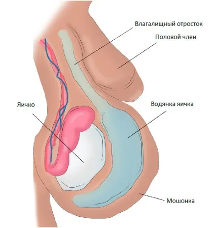 Водянка яєчка - симптоми, причини, діагностика, методи лікування водянки ляічка, профілактика і