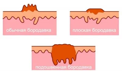 Вульгарні бородавки причини, симптоми і лікування
