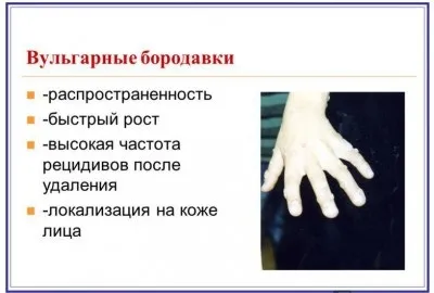 Вульгарні бородавки причини, симптоми і лікування