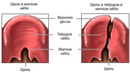 Хейлопластика у дітей (пластика губ) - лікування, фото, ціна, відгуки (хейлопластика) Хейлопластика у дітей (пластика губ) - лікування, фото, ціна, відгуки