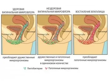Зеленуваті виділення у жінок (жінок) Зеленуваті виділення у жінок