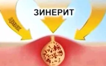 Зінеріт від прищів корисні властивості, застосування, переваги, протипоказання, допомога чи шкода, (прищів) Зінеріт від прищів корисні властивості, застосування, переваги, протипоказання, допомога чи шкода,