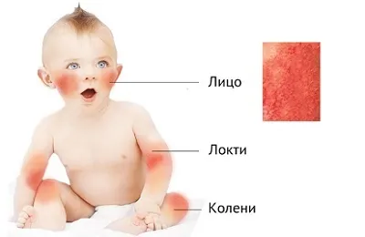 Атопічний дерматит у немовляти лікування, причини та симптоми (атопічний) Атопічний дерматит у немовляти лікування, причини та симптоми