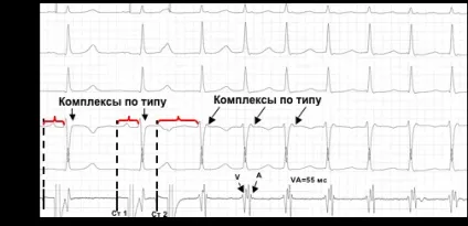 Атріовентрикулярна вузлова реципрокні тахікардії - доказова медицина для всіх (атріовентрикулярна) Атріовентрикулярна вузлова реципрокні тахікардії - доказова медицина для всіх