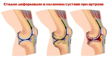 Артроз коліна - діагностика і лікування (артрозу колінного суглоба) Артроз коліна - діагностика і лікування