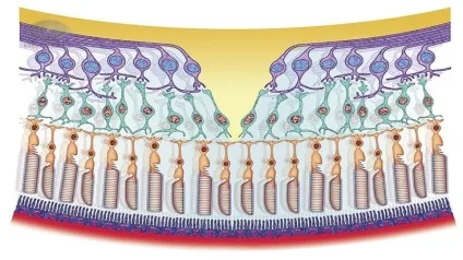 Абіотрофія сітківки тапеторетинальна, пігментна, лікування (тапеторетинальна) Абіотрофія сітківки тапеторетинальна, пігментна, лікування