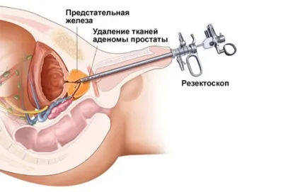 Аденома простати і її лікування народними засобами (лікування) Аденома простати і її лікування народними засобами