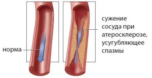 Ангіоспазм, вазоспазм судин мозку і інших органів, як лікувати (лікувати) Ангіоспазм, вазоспазм судин мозку і інших органів, як лікувати