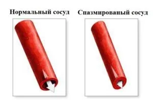 Ангіоспазм, вазоспазм судин мозку і інших органів, як лікувати (судин) Ангіоспазм, вазоспазм судин мозку і інших органів, як лікувати