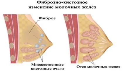 Анехогенние утворення в молочній залозі що це, лікування (лікування) Анехогенние утворення в молочній залозі що це, лікування
