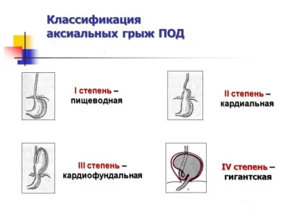 Аксіальна грижа - причини розвитку і методи лікування (причини) Аксіальна грижа - причини розвитку і методи лікування