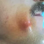 Атерома на обличчі фото, лікування й видалення пухлини (особі) Атерома на обличчі фото, лікування й видалення пухлини