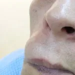 Атерома на обличчі фото, лікування й видалення пухлини (фото) Атерома на обличчі фото, лікування й видалення пухлини