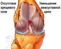 Артроз суглобів, ми лікуємо