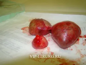 Атерома на обличчі чомусь з'являються і методи видалення (особі) Атерома на обличчі чомусь з'являються і методи видалення