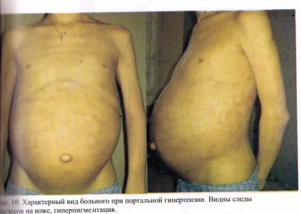Асцит черевної порожнини при онкології, раку шлунка і кишечника, канцероматозе очеревини - прогноз, (онкології) Асцит черевної порожнини при онкології, раку шлунка і кишечника, канцероматозе очеревини - прогноз,