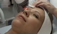 Безопераційна блефаропластика (пластика повік) - що це таке, ціни, відгуки, фото до і після (безопераційна) Безопераційна блефаропластика (пластика повік) - що це таке, ціни, відгуки, фото до і після