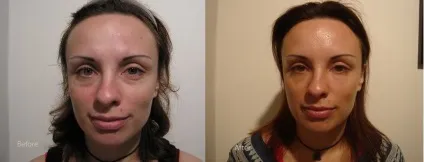 Безопераційна блефаропластика (пластика повік) - що це таке, ціни, відгуки, фото до і після (блефаропластика) Безопераційна блефаропластика (пластика повік) - що це таке, ціни, відгуки, фото до і після