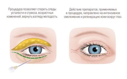 Безопераційна блефаропластика ін'єкційна і апаратна відгуки та фото (відгуки) Безопераційна блефаропластика ін'єкційна і апаратна відгуки та фото