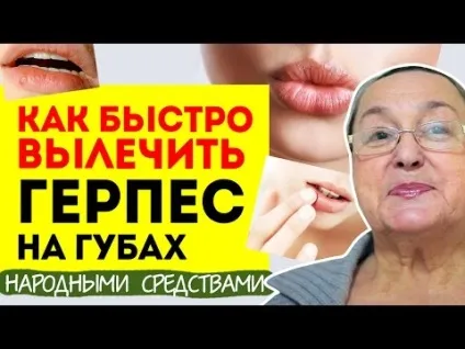 Швидке лікування герпесу як і чим прибрати на губах (прибрати) Швидке лікування герпесу як і чим прибрати на губах