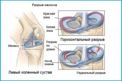Біль в кістки гомілки спереду, ззаду - причини, перша допомога (кістки) Біль в кістки гомілки спереду, ззаду - причини, перша допомога