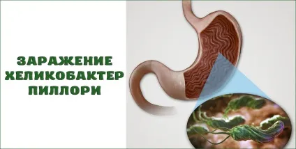 Що робити при загостренні гастриту (виробленні соляної кислоти) Що робити при загостренні гастриту