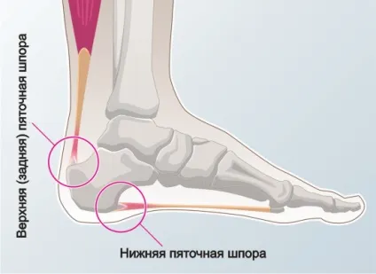 Що таке шпора на п'яті як виглядає, різновиди, діагностика, методи лікування, наслідки (різновиди) Що таке шпора на п'яті як виглядає, різновиди, діагностика, методи лікування, наслідки