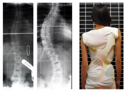 Що таке фізіологічні вигини хребта (хребта) Що таке фізіологічні вигини хребта