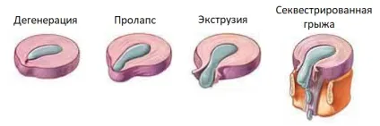 Дегенеративно-дистрофічні зміни шийного відділу хребта (шийного) Дегенеративно-дистрофічні зміни шийного відділу хребта