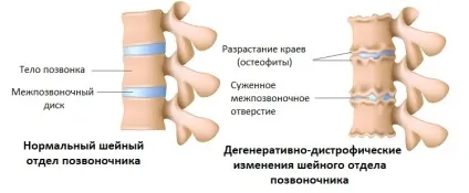 Дегенеративно-дистрофічні зміни шийного відділу хребта (шийного) Дегенеративно-дистрофічні зміни шийного відділу хребта