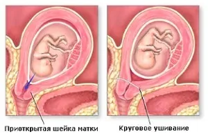 Діагностика і лікування ІЦН під час вагітності (вагітності) Діагностика і лікування ІЦН під час вагітності