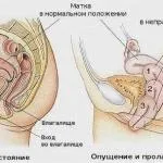 Дипроспан це гормональний препарат чи ні