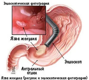 Для чого проводиться гастродуоденоскопія, її види (шлунка дванадцятипалої кишки) Для чого проводиться гастродуоденоскопія, її види
