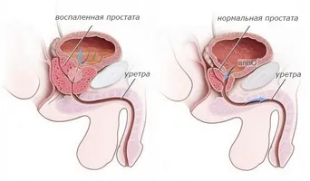 Ефективне лікування гіперплазії передміхурової залози народними засобами які продукти забезпечать (передміхурової) Ефективне лікування гіперплазії передміхурової залози народними засобами які продукти забезпечать