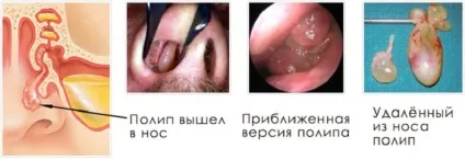Двосторонній синусит симптоми, лікування і причини