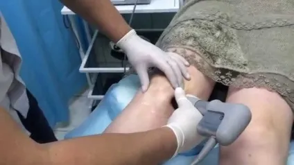 двосторонній гонартроз