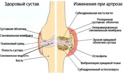 Двосторонній гонартроз 1, 2, 3, 4 ступеня причини виникнення, симптоми, лікування (причини) Двосторонній гонартроз 1, 2, 3, 4 ступеня причини виникнення, симптоми, лікування