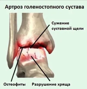 Ендопротезування гомілковостопного суглоба 2 (артрозу гомілковостопного суглоба) Ендопротезування гомілковостопного суглоба 2