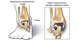 Ендопротезування гомілковостопного суглоба 2 (артрозу гомілковостопного суглоба) Ендопротезування гомілковостопного суглоба 2