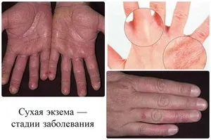 Екзема народні засоби для лікування в домашніх умовах, як лікувати захворювання на руках