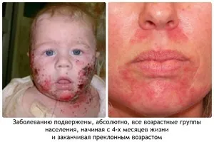 Екзема народні засоби для лікування в домашніх умовах, як лікувати захворювання на руках