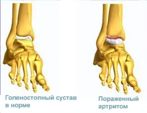 Ендопротезування гомілковостопного суглоба 2 (артрозу гомілковостопного суглоба) Ендопротезування гомілковостопного суглоба 2