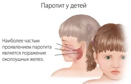 Епідемічний паротит у дітей симптоми, шляхи зараження, методи леченіясвінкі у дітей та можливі (паротит) Епідемічний паротит у дітей симптоми, шляхи зараження, методи леченіясвінкі у дітей та можливі