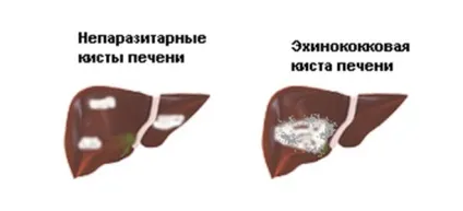 Ехінококоз у людини симптоми і лікування (ехінококоз) Ехінококоз у людини симптоми і лікування